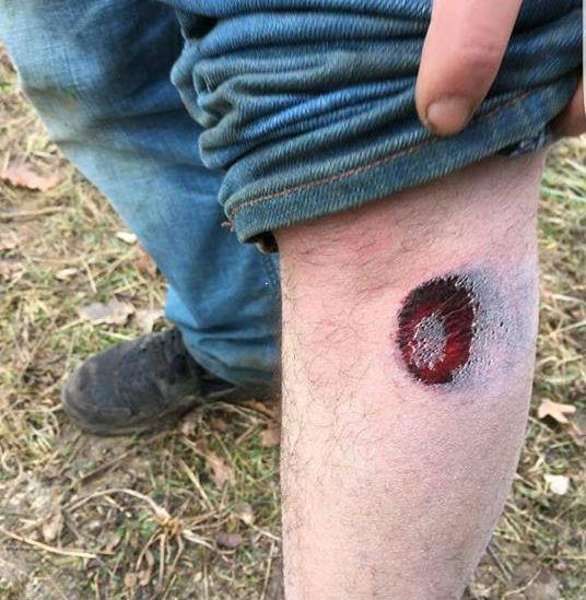 Un teufeur a été blessé à la jambe par un tir de flash-ball