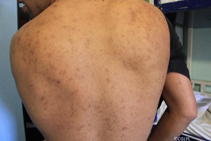 Les marques laissées sur le dos d'un détenu par les punaises.
