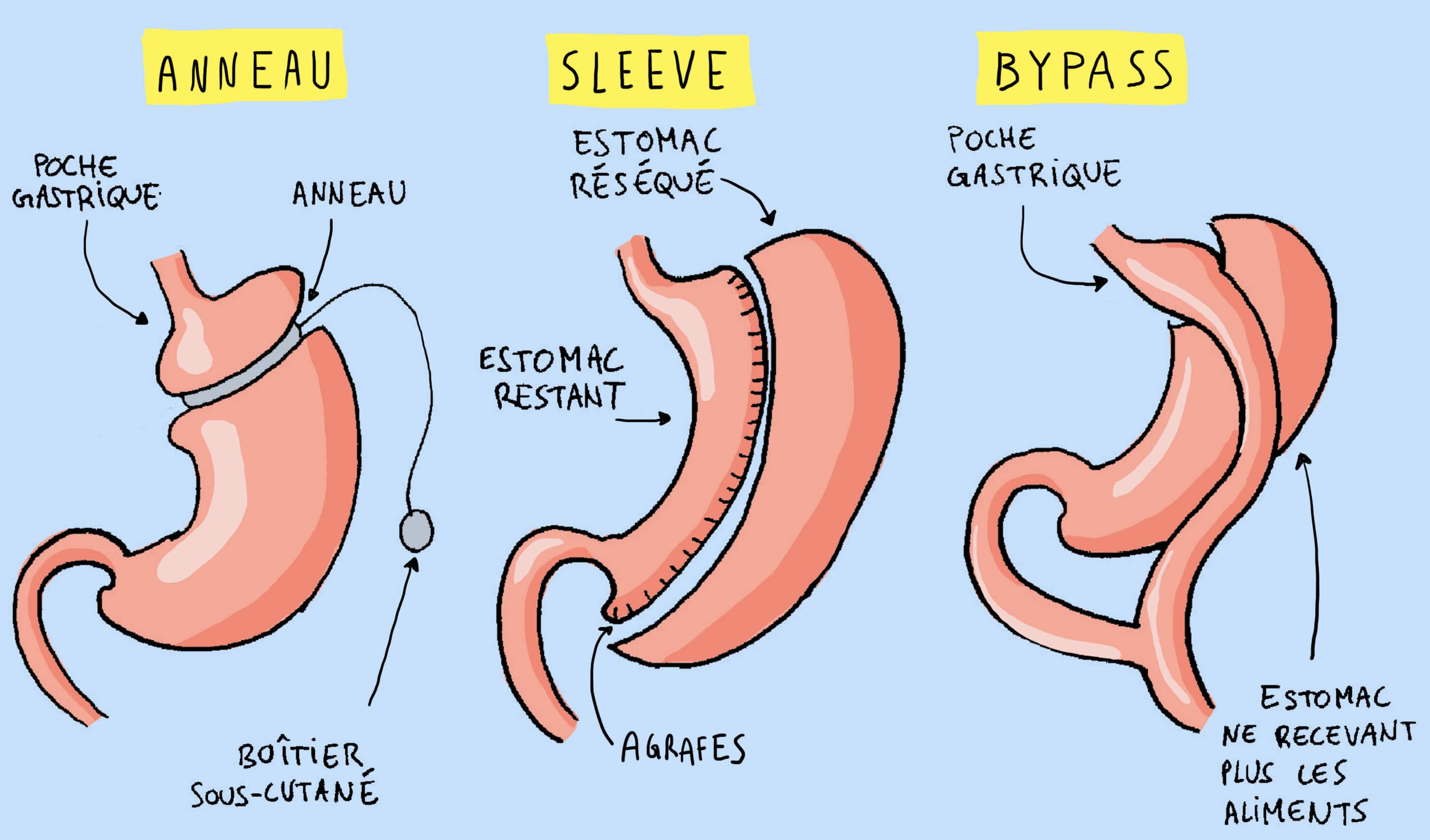 Différentes chirurgies bariatriques mode d'emploi.