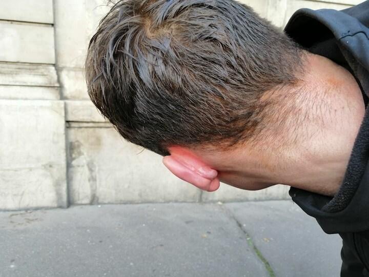 Luc montre l’arrière de son crâne et son oreille avec une boule enflée à l'intérieur après un coup. Il a aussi des traces de sang sur la nuque et les yeux rouges