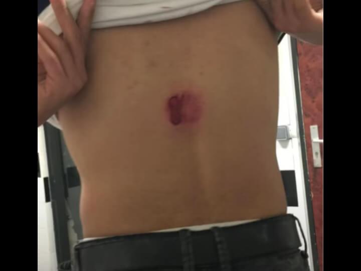 Avant ses contrôles violents avec la Bac et la police, Aymen s’était déjà fait tirer dans le dos par un flashball à bout portant, début 2018