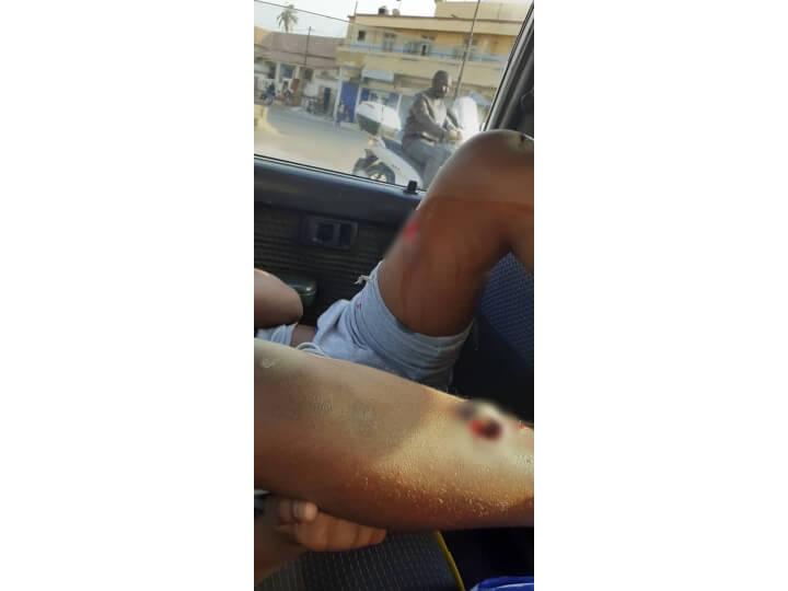 Les éclats de grenades GM2L peuvent causer d’énormes trous dans la peau, comme la photo ici d'un manifestant.