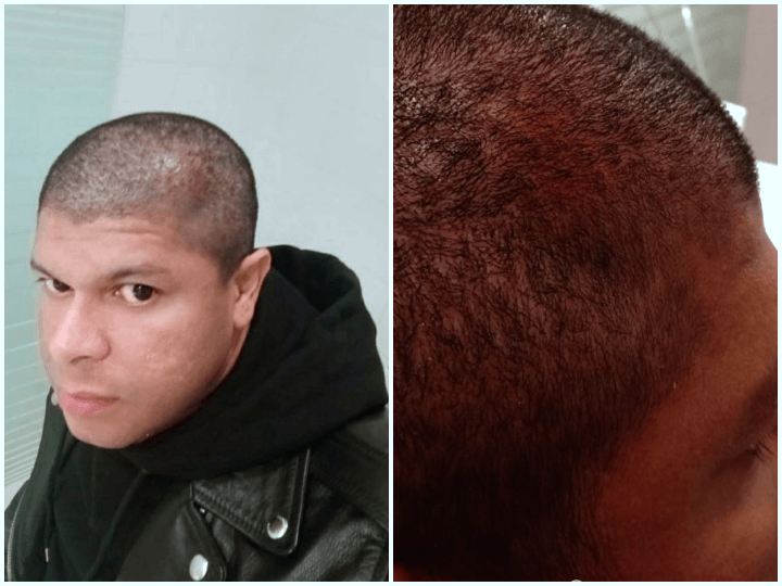 De retour à son domicile Otiniels se rase la tête, et découvre un hématome rouge au-dessus de l'œil gauche, au niveau de la tête