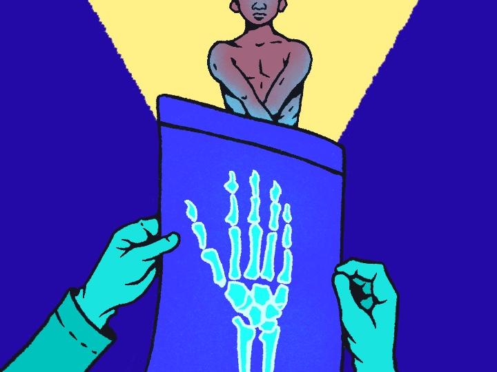 StreetPress a d’ailleurs découvert qu’en plus de ces tests osseux, certains jeunes ont subi des examens pubertaires au sein du CHU de Montpellier, une pratique interdite par la loi depuis 2016 et qui a pourtant continué dans l’Hérault jusqu’en 2020.