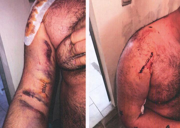 Après le cassage de son bras, Clément a été opéré dans la foulée. Il a reçu 35 agrafes, a été immobilisé pendant six semaines et a reçu 60 jours d'ITT.