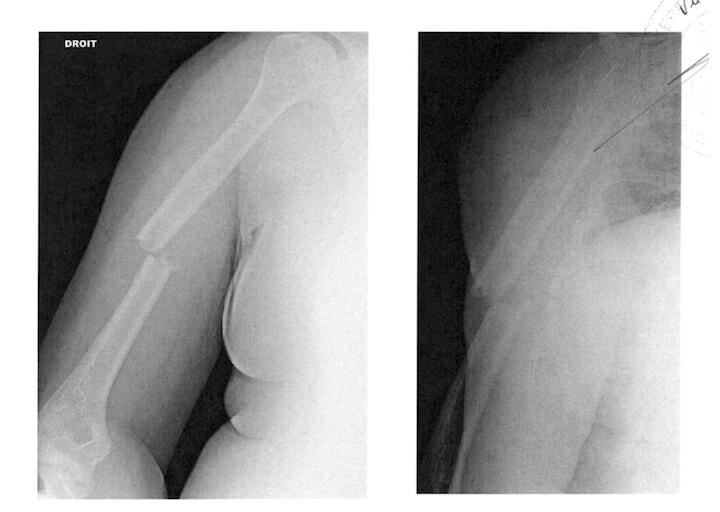Selon Clément, c'est le policier Aymeric-Bertrand M. qui lui a remonté son bras droit menotté vers l'avant, entraînant la fracture totale de son os.
