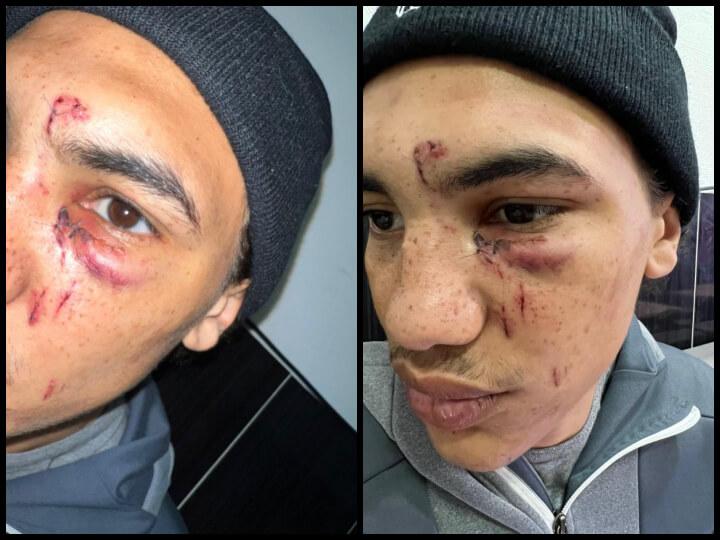 Une fois en garde à vue, Tidiane passe devant un toubib suite à cette interpellation violente. Il lui pose trois points de suture à l'arcade sourcilière, deux entre les yeux, constate un coquard et lui délivre trois jours d'incapacité totale de travail