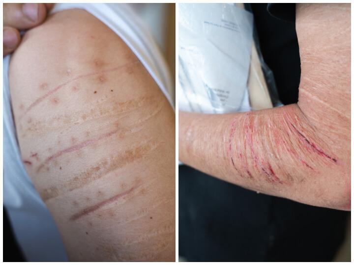 Les retenus montrent leurs scarifications. Sur la photo de droite, celles de Tahir