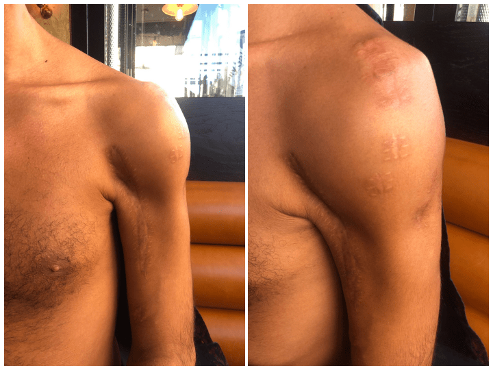 Encore aujourd'hui Nordine garde les cicatrices de ses blessures