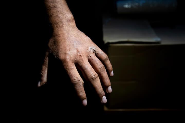 Le Samu Social affirme avoir vu le compteur des cas de gale exploser.