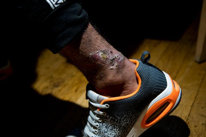 Les lésions peuvent se développer sur tout le corps