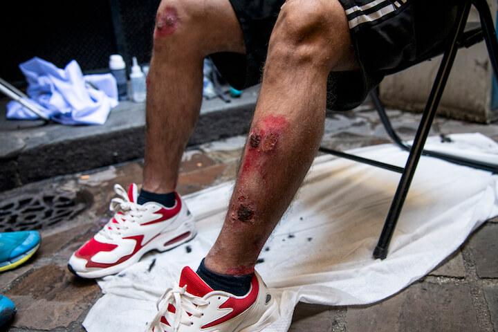 « La situation est d’autant plus compliquée que nous traitons beaucoup de cas de gale surinfectées, avec des plaies importantes sur les lésions », raconte la docteure Mathilde Garé