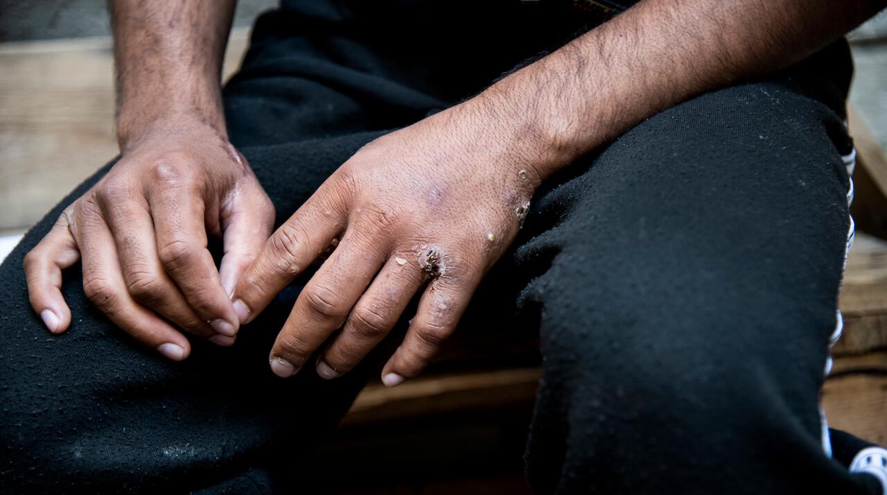 Pourquoi le vaccin fait flipper les Français