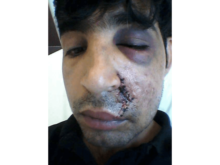 Janan au lendemain de son agression à Calais