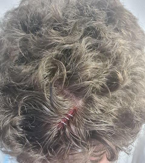 Le trentenaire a également reçu des coups à la tête, et en garde « une plaie au cuir chevelu agrafée », selon le certificat médical