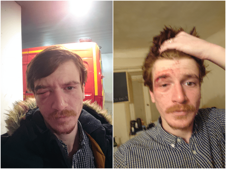 À Marseille, Alexandre, militant LGBTQIA+, a perdu un œil après un coup de poing d’un policier.