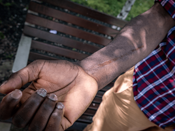 Kélé a des séquelles à vie de l’accident survenu en 2018. Une perceuse de son école lui a brisé le bras en deux, sectionnant os, nerfs et tendons