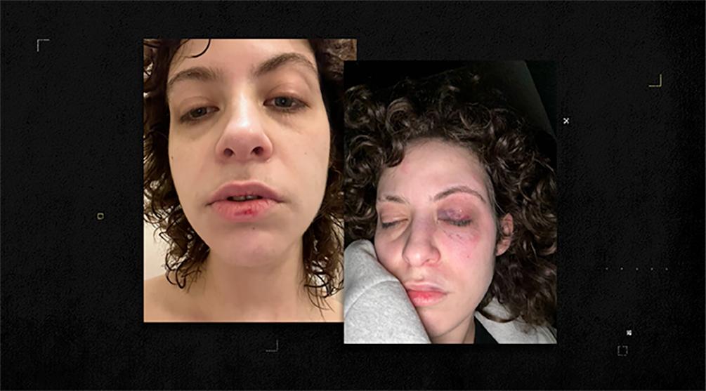 Loubna publie sur les réseaux sociaux une photo avec son œil au beurre noir