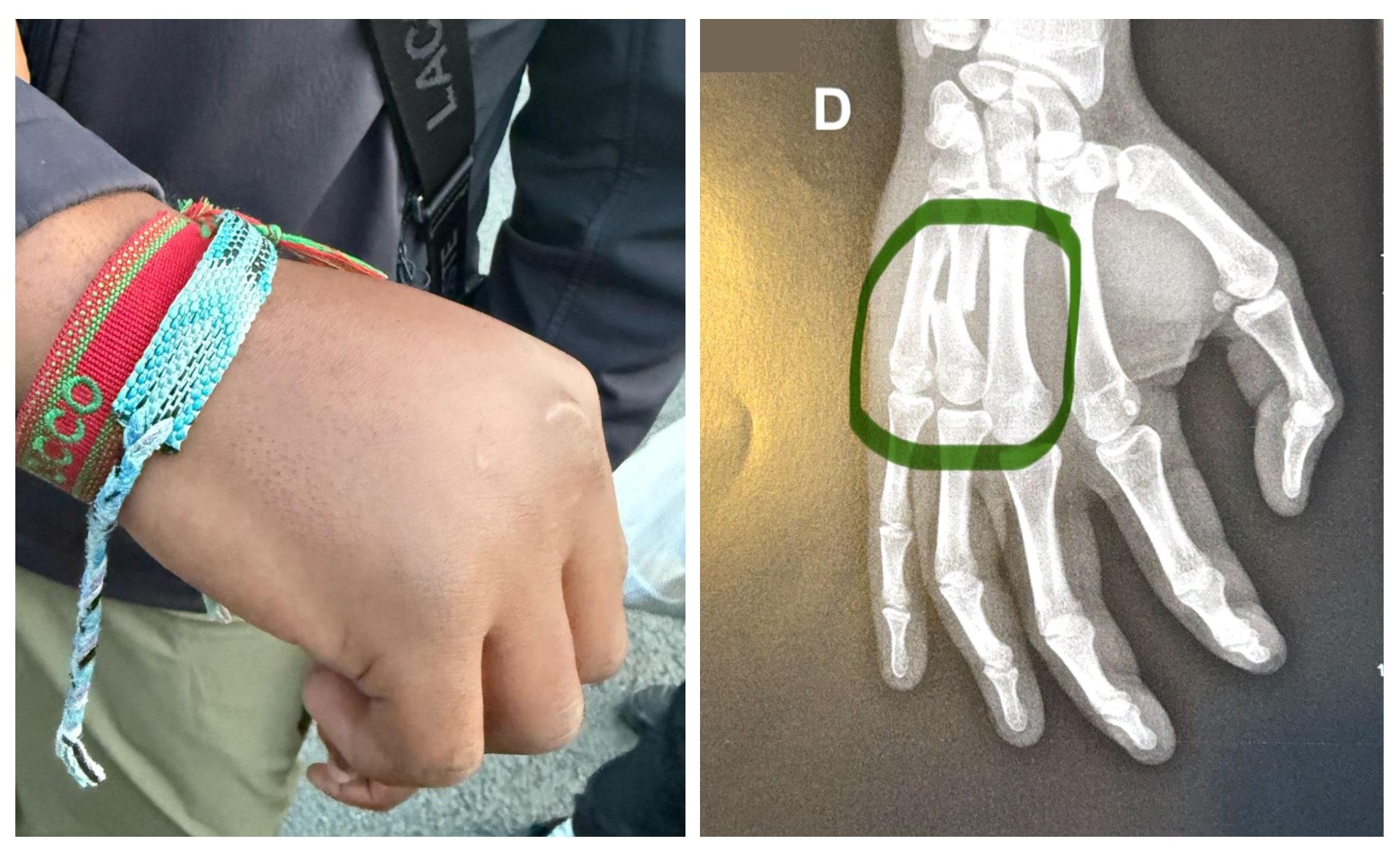 Photo de la main droite d’Adrian le 27 avril, après le départ des agents et radiographie du 29 avril qui montre la fracture