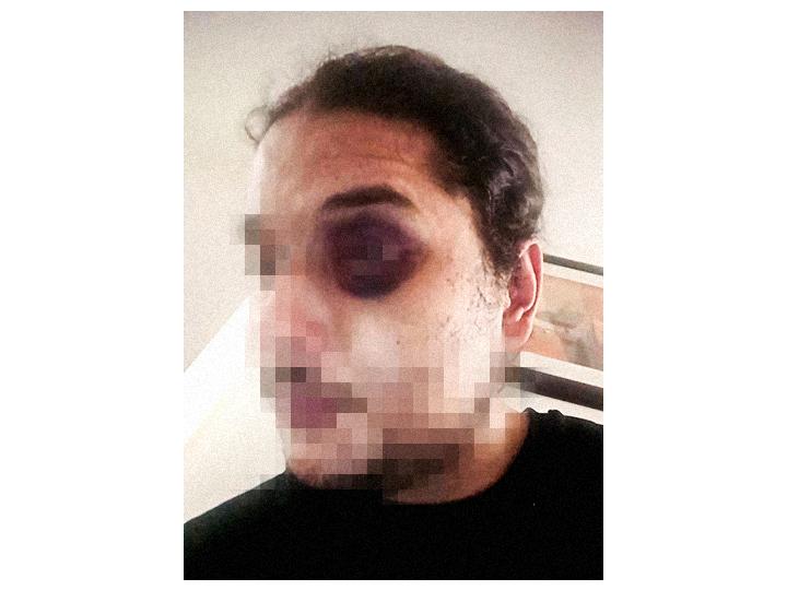 Le médecin a prescrit à Adil dix jours d’ITT, et relève de très nombreuses lésions : une « ecchymose » à l’œil gauche, à la pommette, sur le menton, des « tuméfactions » sur le visage, l’oreille, des « érosions » sur le front, la lèvre, le cou, « une dizaine d’érosions croûteuses » sur les côtes, mais aussi au genou droit, des ecchymoses aux bras, au coude, à l’épaule, au poignet