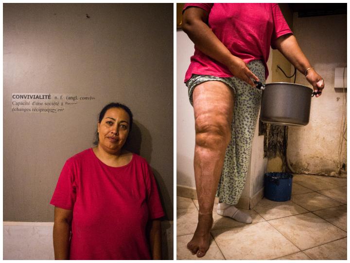 En remplissant une bassine d'eau pour se doucher, la jambe d'Albana a été brûlée