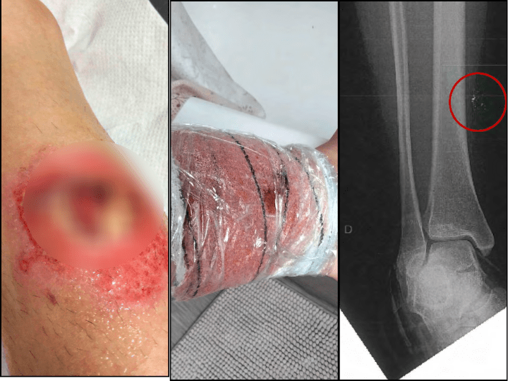 Sur sa jambe, deux larges plaies. Dans l'une, une brûlure au second degré ; dans l'autre, des « éclats métalliques millimétriques d'aspect compatible à la grenade lacrymogène » — une grenade GM2L à priori